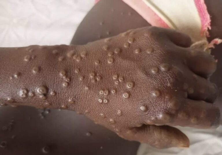 Mpox en RDC : 548 morts depuis le début de l&rsquo;année